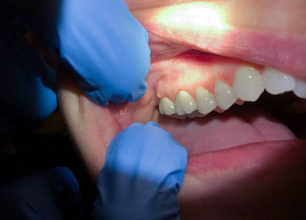 Best Emergency Treatment for Dental Infections or Abscesses in Esko, MN